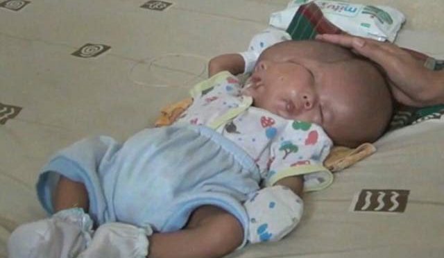 دو موئی بچوں کی پیدائش والدین بے بسی کی تصویر ،تصاویر دیکھ کر سب دنگ رہ گئے