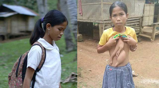 فلپائنی لڑکی اپنے پیٹ پر چپکے دو اضافی بازوؤں سے پریشان
