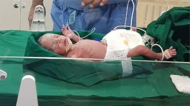 انڈیا: رحم مادر کے ٹرانسپلانٹ سے پیدا ہونے والی پہلی بچی