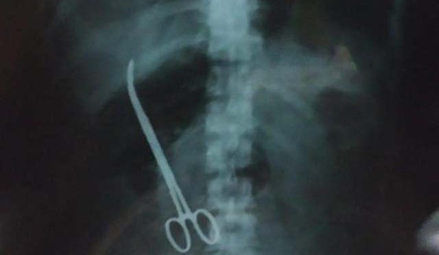 مریضہ کے پیٹ میں رہ جانے والی قینچی کو 3 ماہ بعد نکال لیا گیا