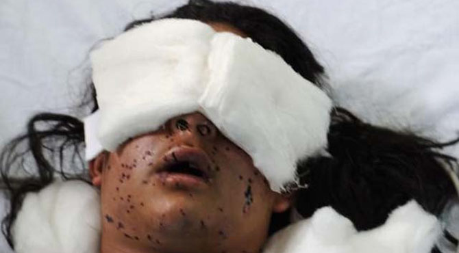 بھارتی فوج کی پیلٹ گولیوں سے ایک ہزار سے زائد کشمیریوں کی بینائی متاثر ہوئیں