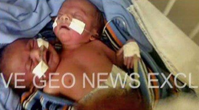 میرپور خاص میں دو سر والے بچے کی پیدائش، زندگی کو خطرات لاحق