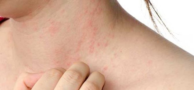 الرجی کیا ہے اور اسے کیسے روکا جائے؟