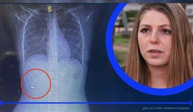 کمر میں لگنے والی گولی سے بے خبرخاتون کا 3 ماہ بعد کامیاب آپریشن