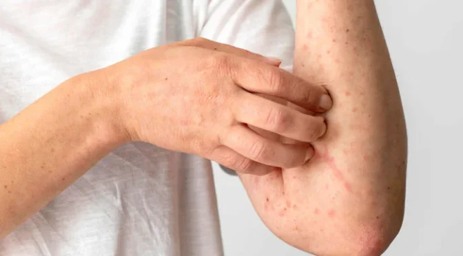 جلد کی 4 تبدیلیاں جگر کی خرابی کی علامت ہو سکتی ہیں — ماہرین