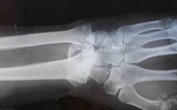 مہینوں میں ٹھیک ہونے والی ہڈیوں کو اب منٹوں میں جوڑنے والی گوند تیار