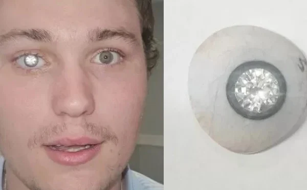 شہری نے بینائی کھودینے کے بعد اپنی آنکھ میں ہیرا لگوا کر سب کو حیران کردیا