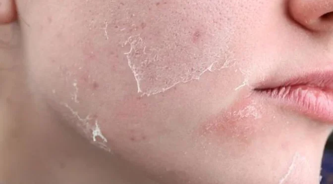 سردیوں میں جلد کو خشک ہونے سے بچانے کیلئے آسان طریقے