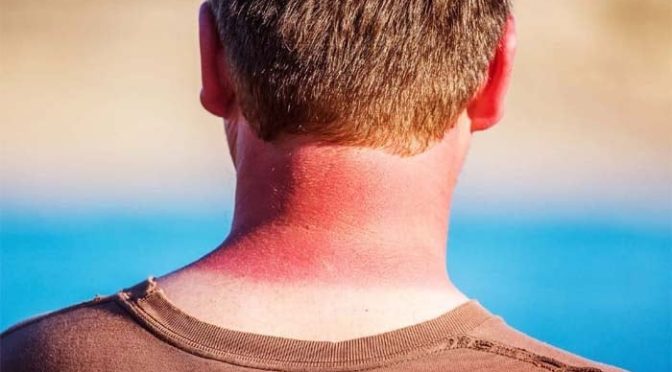 الٹرا وائلٹ شعاعیں سوزش کو بڑھا کر جلد کے کینسر کا سبب بنتی ہیں: تحقیق