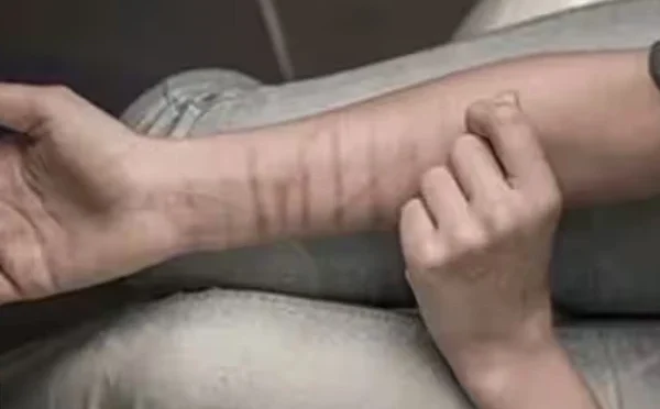 بھارت؛ اسکول کے 35 طلبہ کے ہاتھوں پر پراسرار گہرے زخم کے نشانات