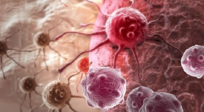 جوان افراد میں تیزی سے عام ہونیوالے آنتوں کے کینسر کی 5 علامات جانیں