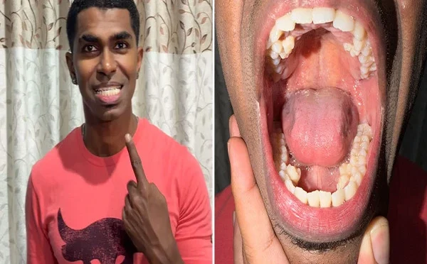 بیالیس  دانتوں والا ملائشین شہری