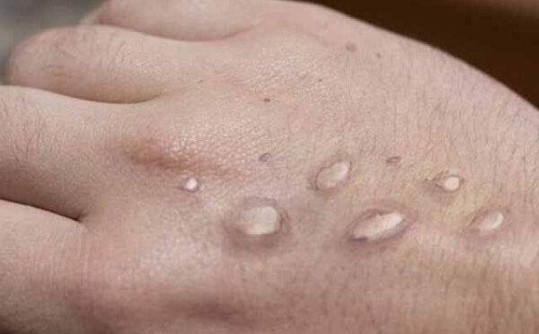 سندھ میں رواں سال منکی پاکس کا تیسرا کیس رپورٹ